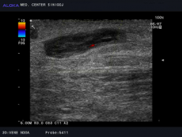 Ultrazvok žil nog - subakutna tromboza vene